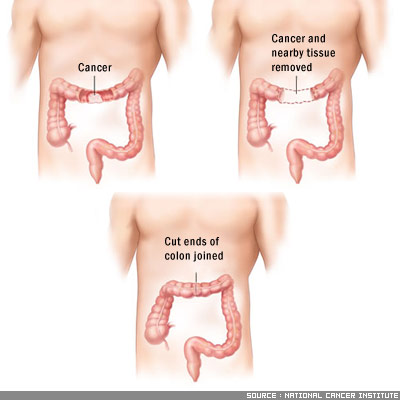 What is a colectomy surgery?
